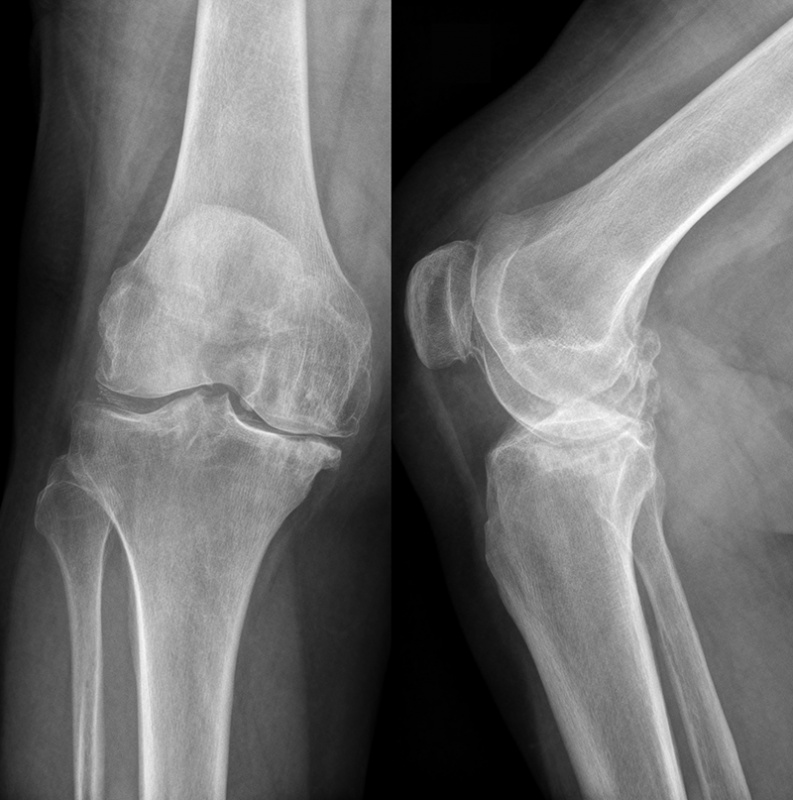 Рентген коленного сустава - цена в Москве: сделать платную рентгенографию коленного сустава